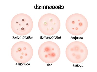 ประเภทของสิว